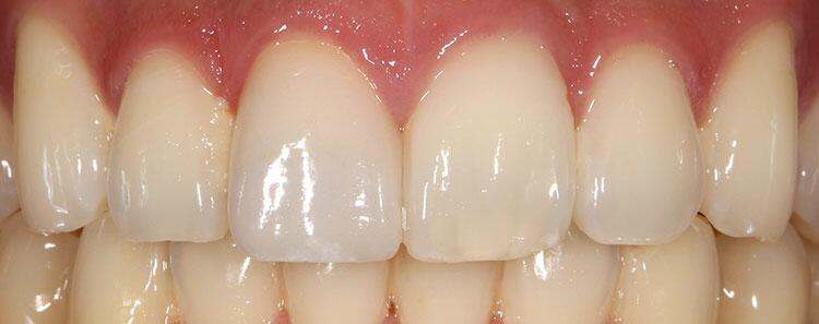 Tooth Restoration Before & After Photo