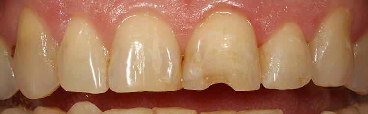 Veneers Before & After Photo