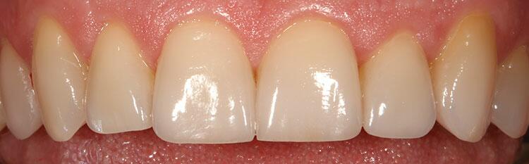 Veneers Before & After Photo