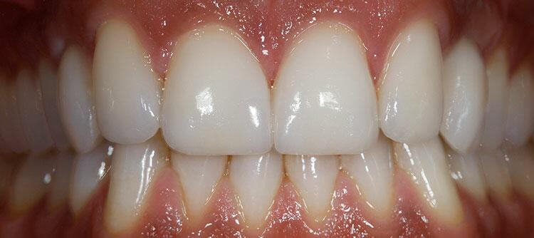 Veneers Before & After Photo