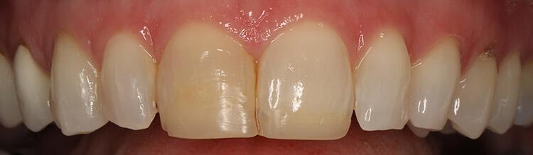 Veneers Before & After Photo