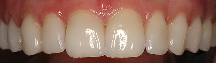 Veneers Before & After Photo