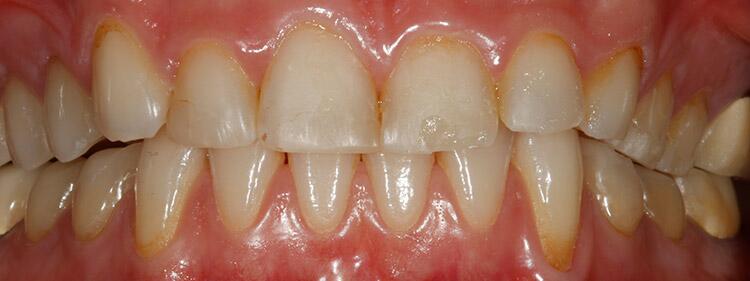 Veneers Before & After Photo