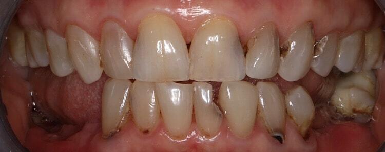 Full Mouth Reconstruction Before & After Photo