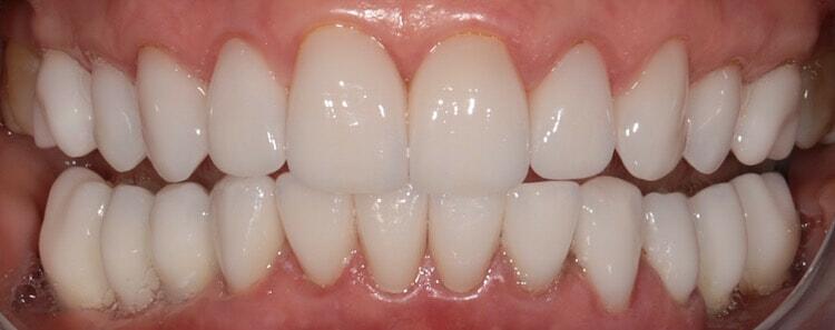 Full Mouth Reconstruction Before & After Photo